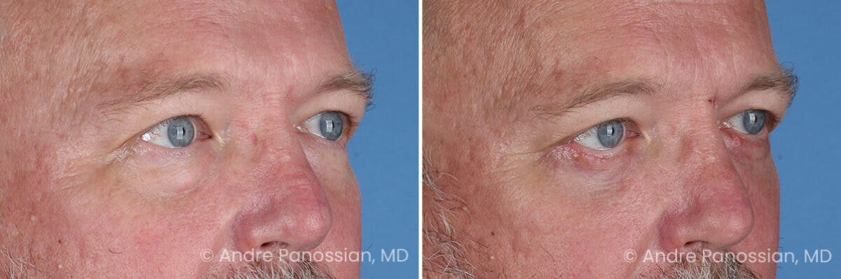 Eyelid Surgery (Blepharoplasty) Before & After Gallery - Patient 162428 - Image 2