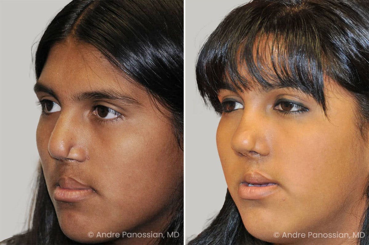 Revision Rhinoplasty Before & After Gallery - Patient 373990 - Image 3
