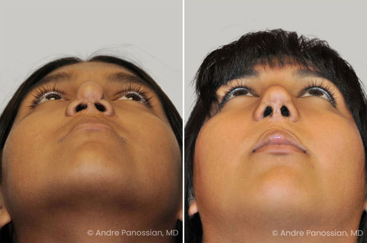 Revision Rhinoplasty Before & After Gallery - Patient 373990 - Image 4