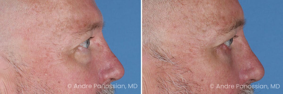 Eyelid Surgery (Blepharoplasty) Before & After Gallery - Patient 162428 - Image 3
