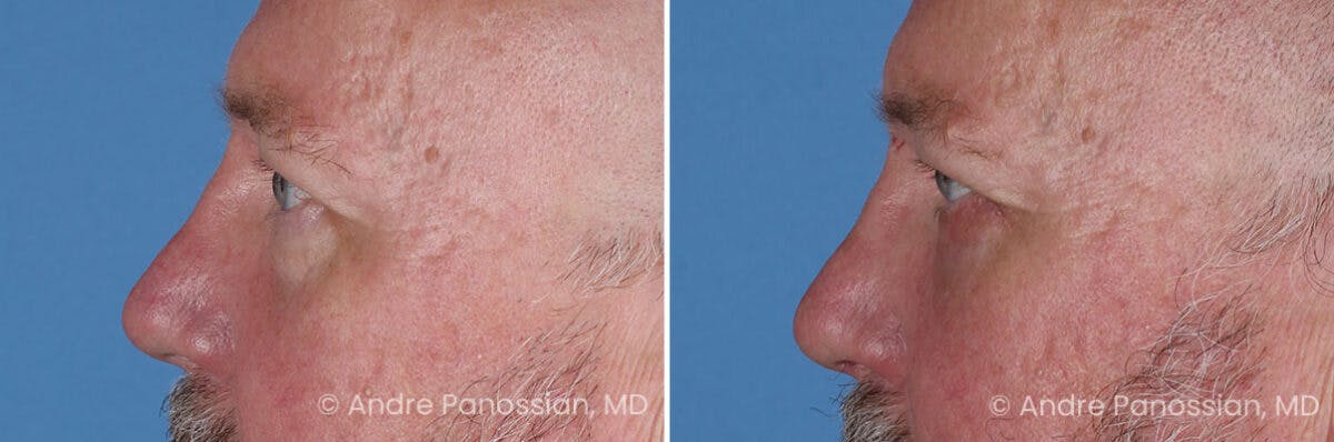 Eyelid Surgery (Blepharoplasty) Before & After Gallery - Patient 162428 - Image 5