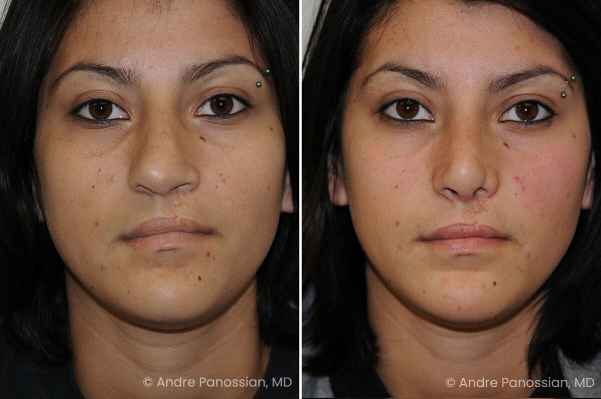 Cleft Lip Rhinoplasty Before & After Gallery - Patient 118971 - Image 2