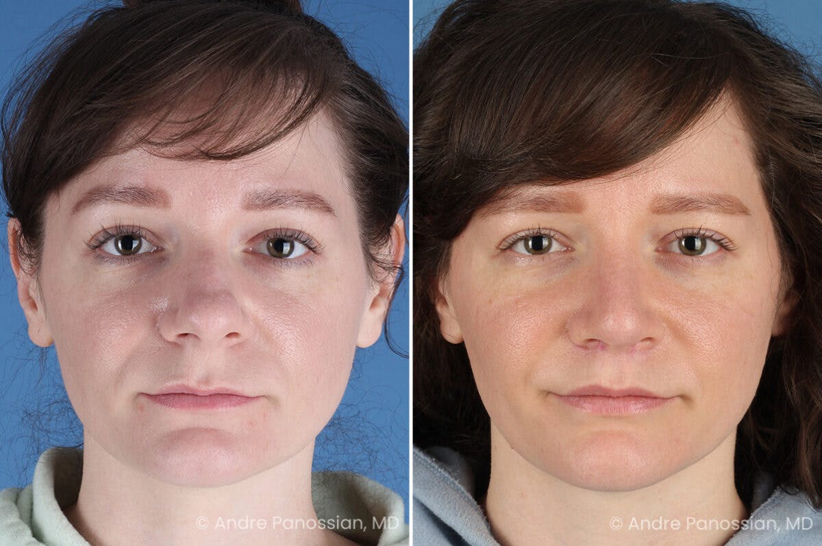 Rhinoplasty Before & After Gallery - Patient 112338 - Image 2