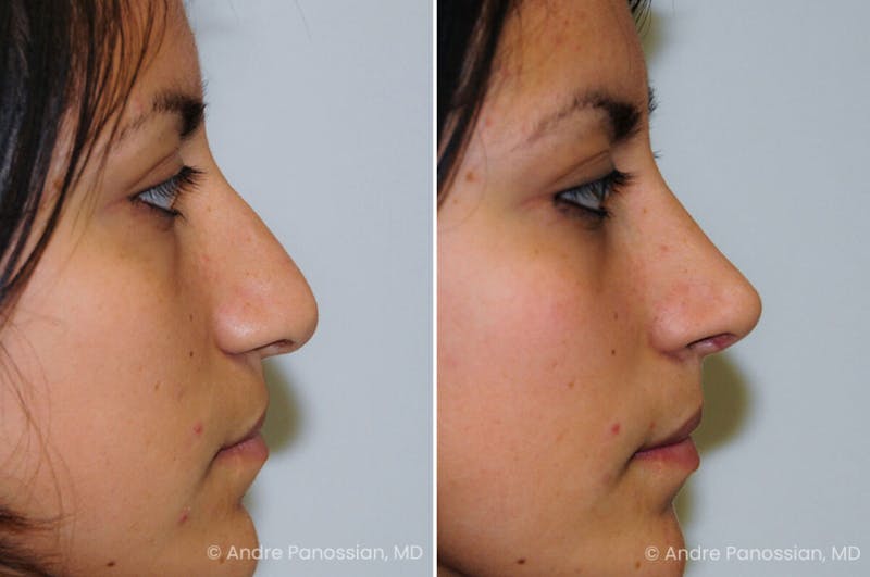 Cleft Lip Rhinoplasty Before & After Gallery - Patient 118971 - Image 1