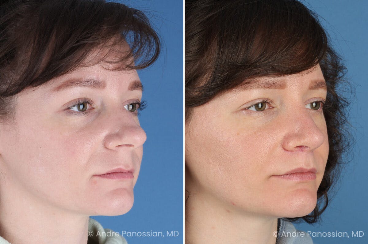 Rhinoplasty Before & After Gallery - Patient 112338 - Image 3