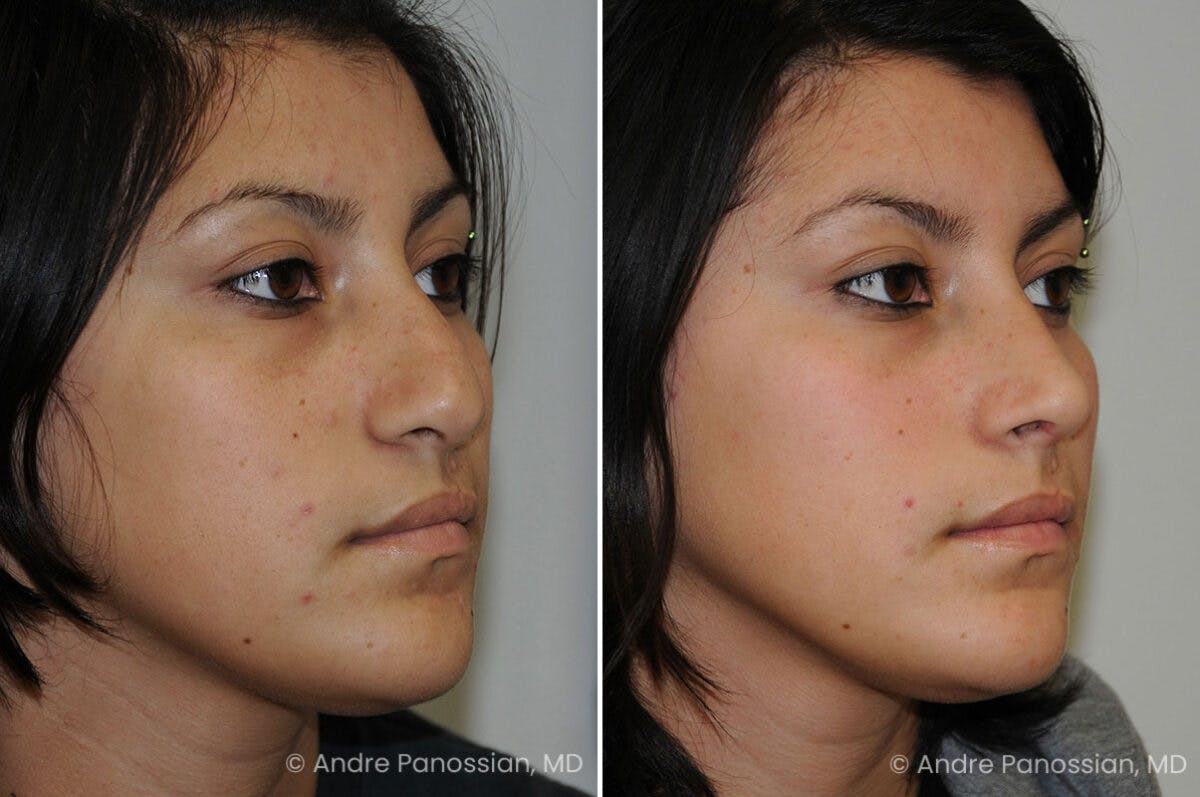 Cleft Lip Rhinoplasty Before & After Gallery - Patient 118971 - Image 3