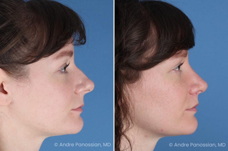 Rhinoplasty Before & After Gallery - Patient 112338 - Image 1