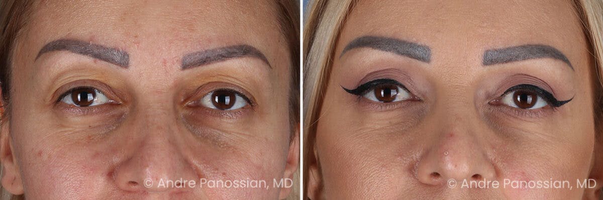 Eyelid Surgery (Blepharoplasty) Before & After Gallery - Patient 254998 - Image 1