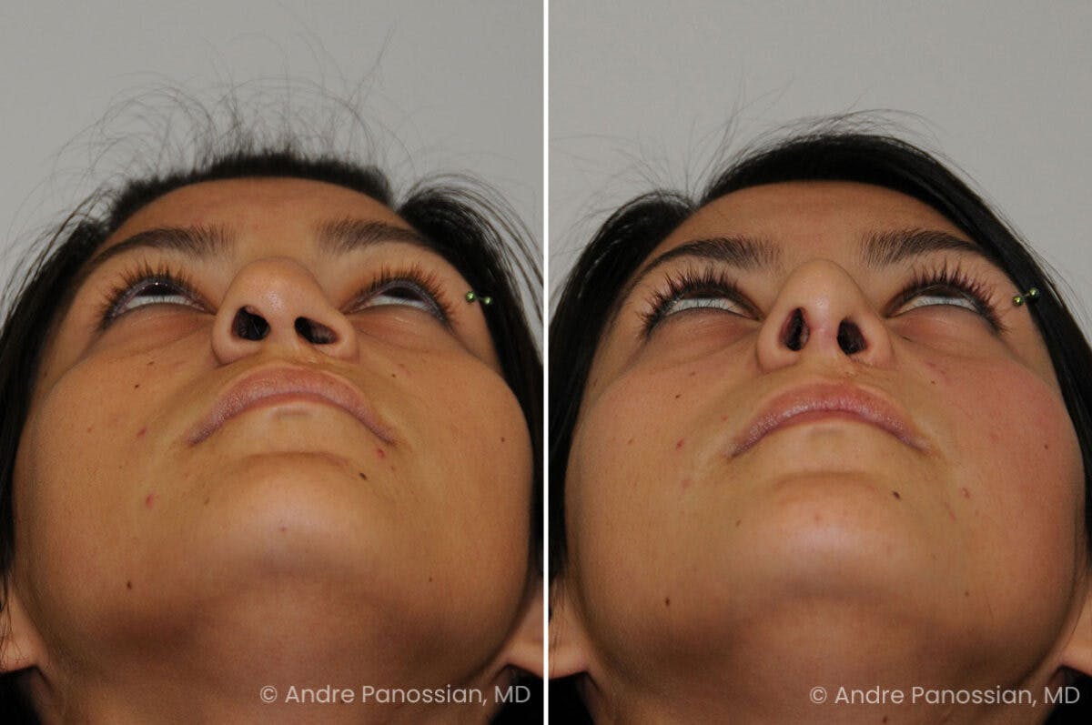 Cleft Lip Rhinoplasty Before & After Gallery - Patient 118971 - Image 4