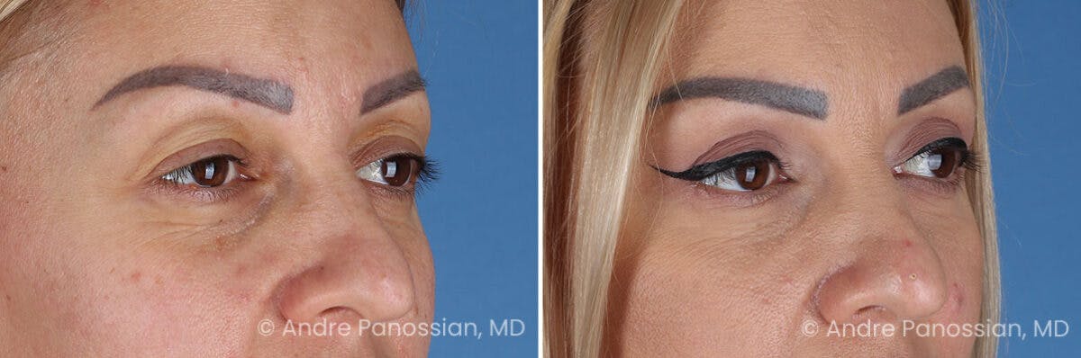 Eyelid Surgery (Blepharoplasty) Before & After Gallery - Patient 254998 - Image 2