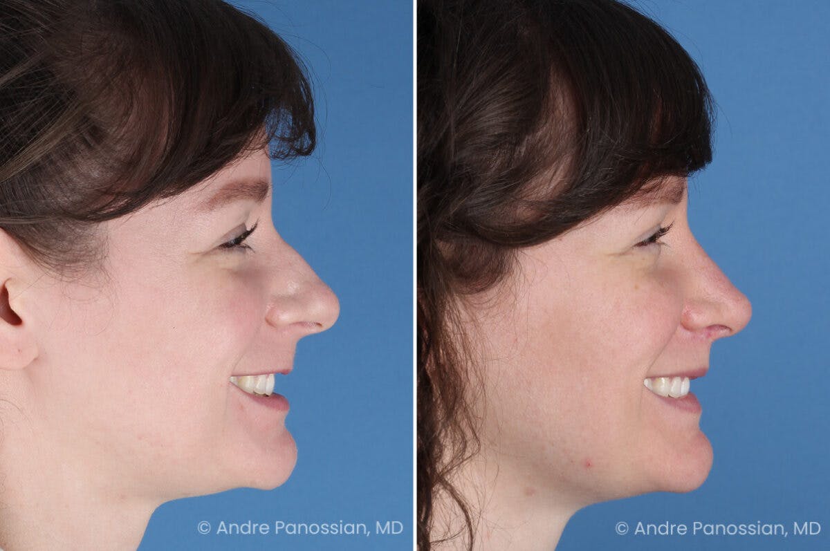 Rhinoplasty Before & After Gallery - Patient 112338 - Image 4
