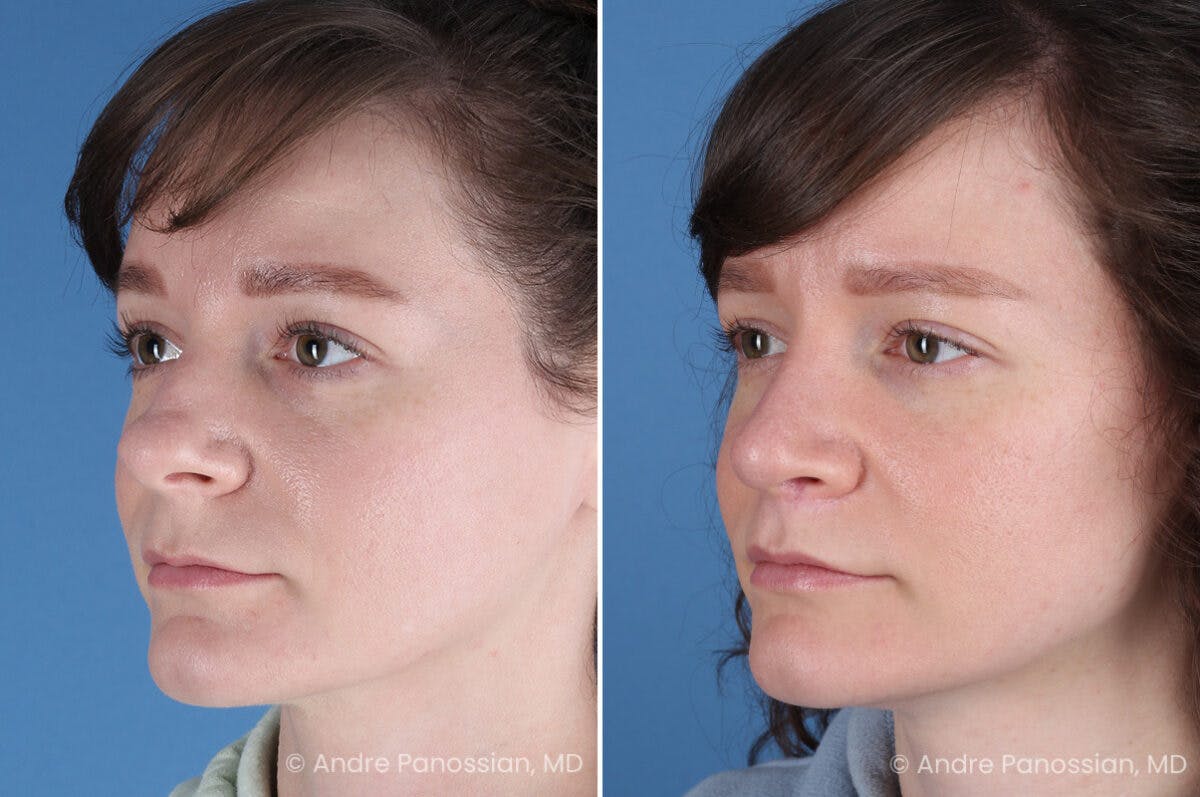 Rhinoplasty Before & After Gallery - Patient 112338 - Image 5