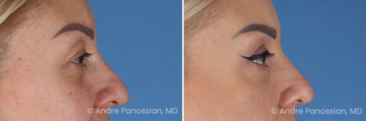 Eyelid Surgery (Blepharoplasty) Before & After Gallery - Patient 254998 - Image 3