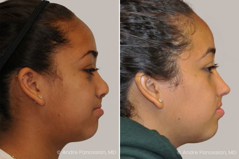 Cleft Lip Rhinoplasty Before & After Gallery - Patient 374080 - Image 1