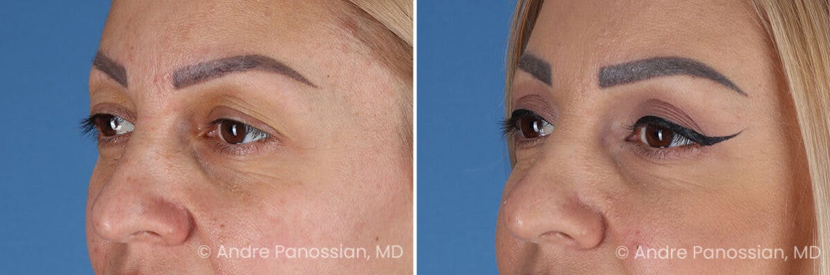 Eyelid Surgery (Blepharoplasty) Before & After Gallery - Patient 254998 - Image 4