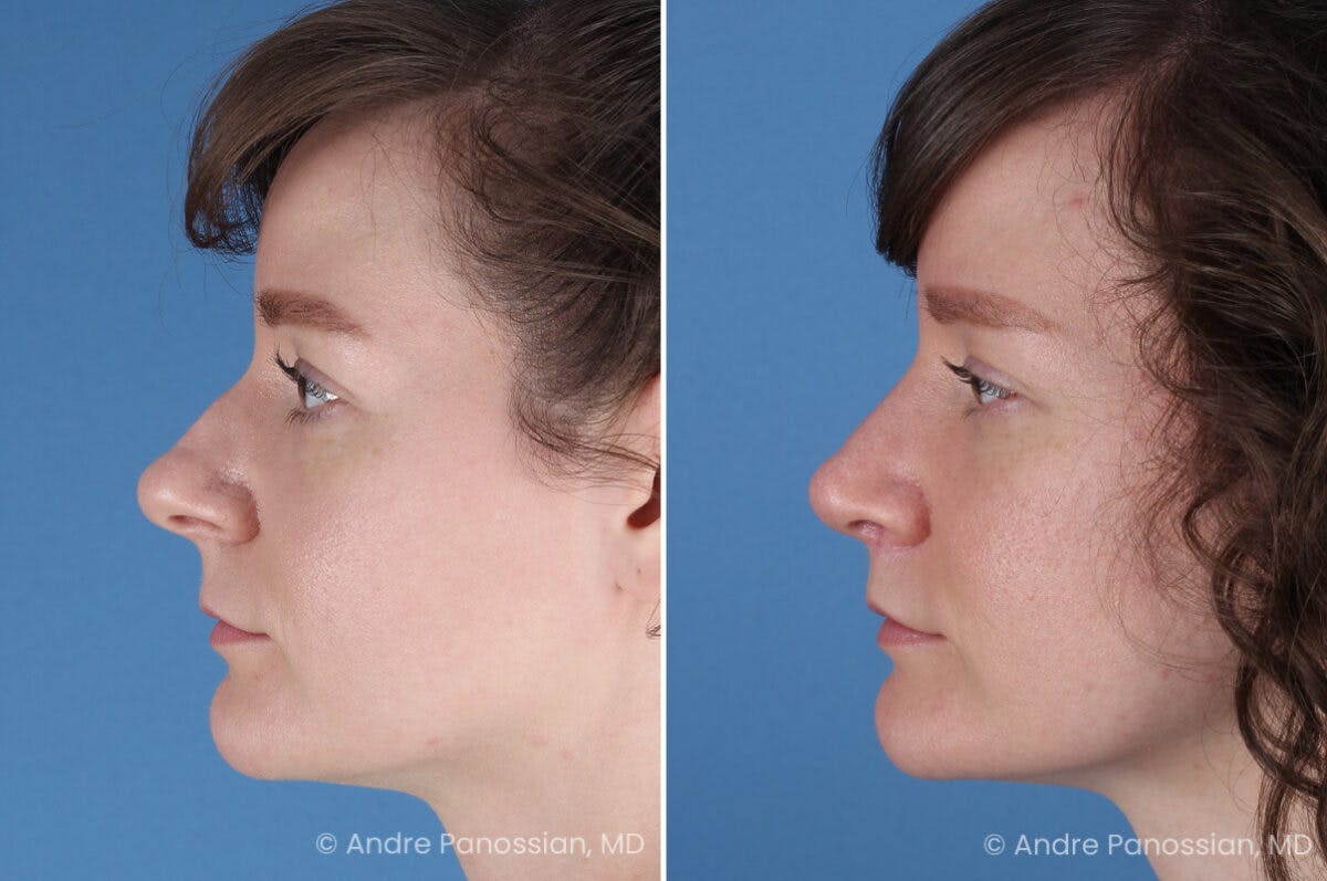 Rhinoplasty Before & After Gallery - Patient 112338 - Image 6