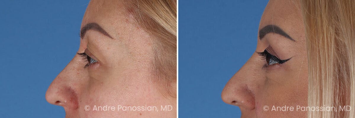 Eyelid Surgery (Blepharoplasty) Before & After Gallery - Patient 254998 - Image 5