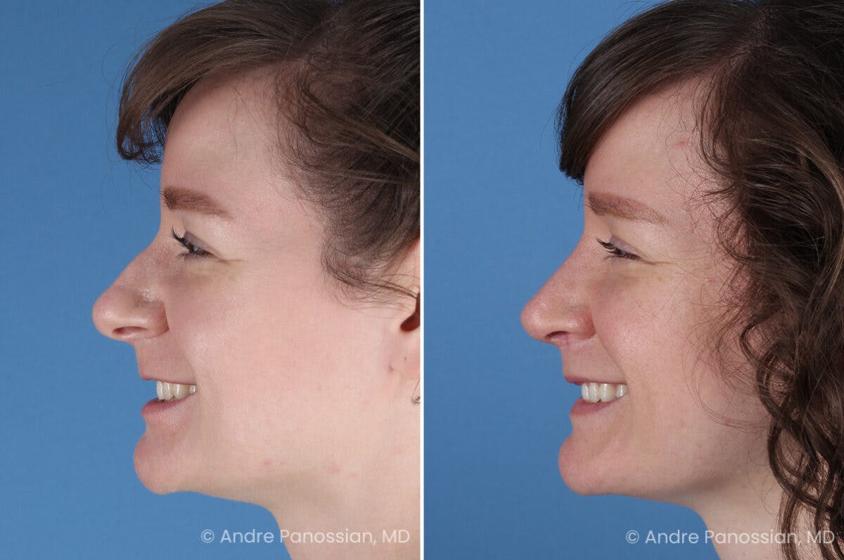 Rhinoplasty Before & After Gallery - Patient 112338 - Image 7
