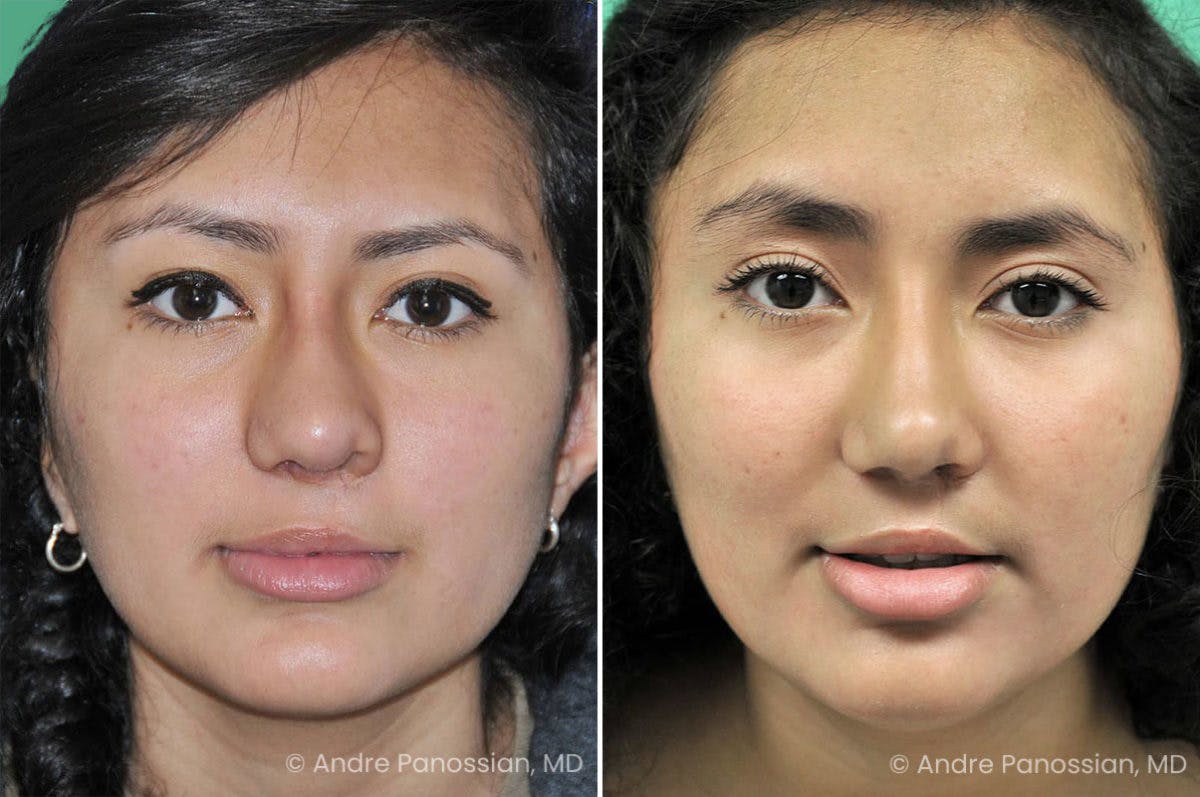 Revision Rhinoplasty Before & After Gallery - Patient 278671 - Image 2