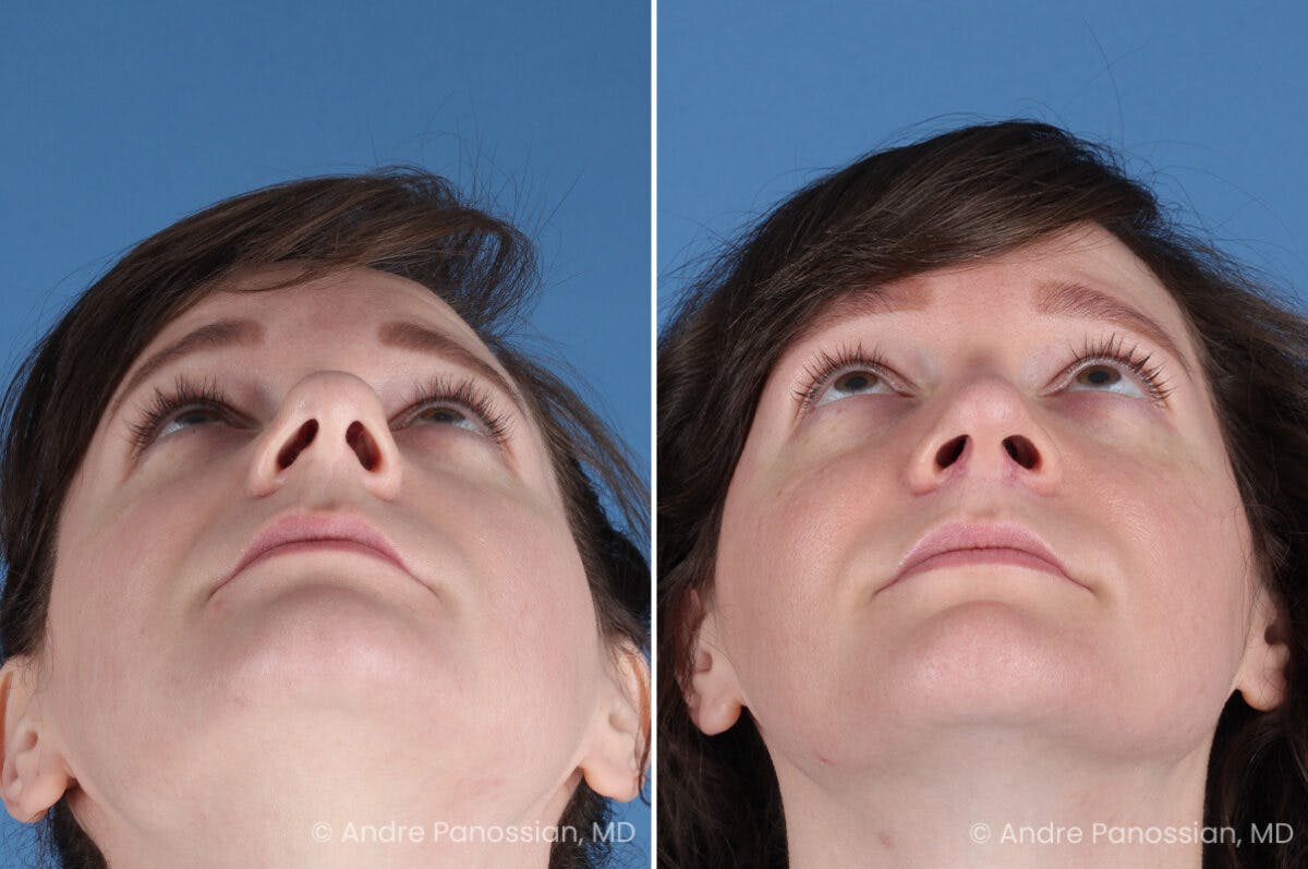 Rhinoplasty Before & After Gallery - Patient 112338 - Image 8