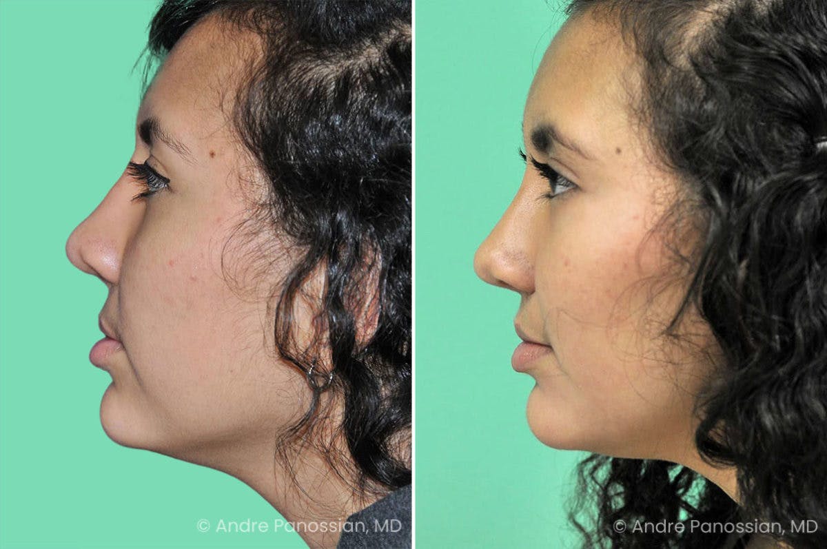 Revision Rhinoplasty Before & After Gallery - Patient 278671 - Image 1