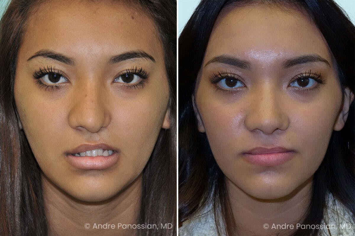 Cleft Lip Rhinoplasty Before & After Gallery - Patient 758720 - Image 2