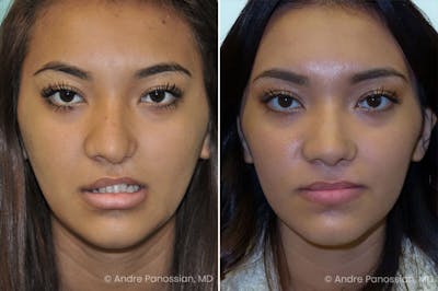 Cleft Lip Rhinoplasty Before & After Photos | Page 2 | Andre Panossian ...