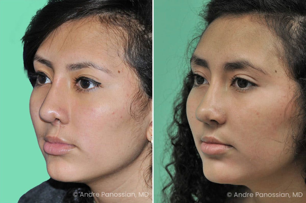 Revision Rhinoplasty Before & After Gallery - Patient 278671 - Image 3