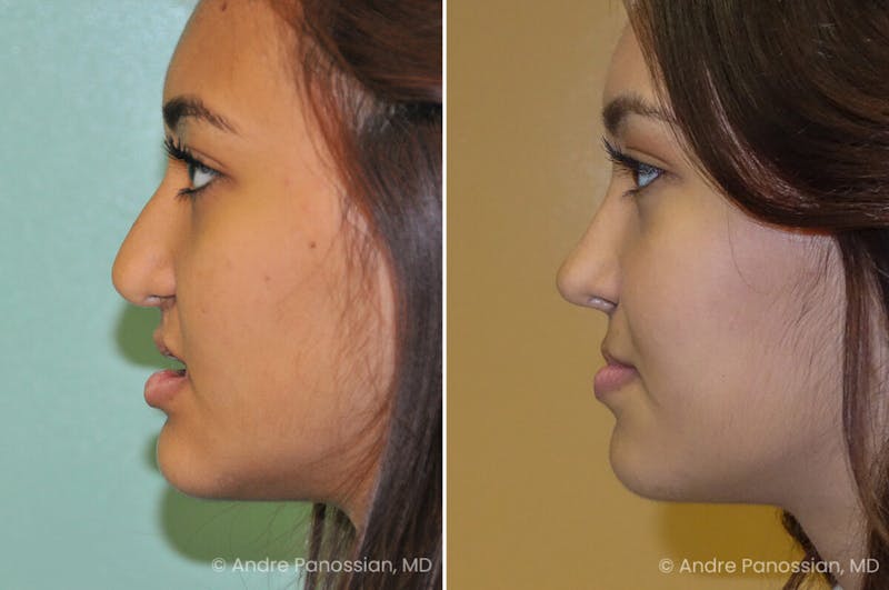 Cleft Lip Rhinoplasty Before & After Gallery - Patient 758720 - Image 1