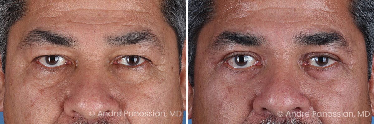 Eyelid Surgery (Blepharoplasty) Before & After Gallery - Patient 389396 - Image 1