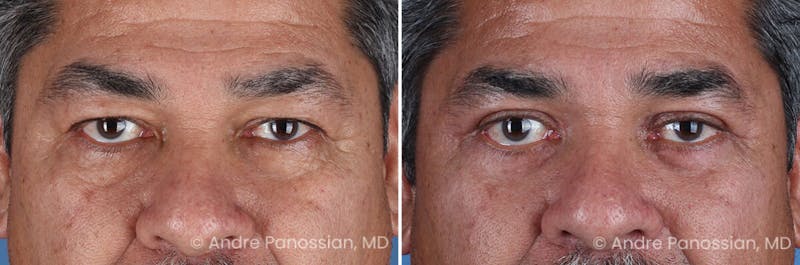 Eyelid Surgery (Blepharoplasty) Before & After Gallery - Patient 389396 - Image 1