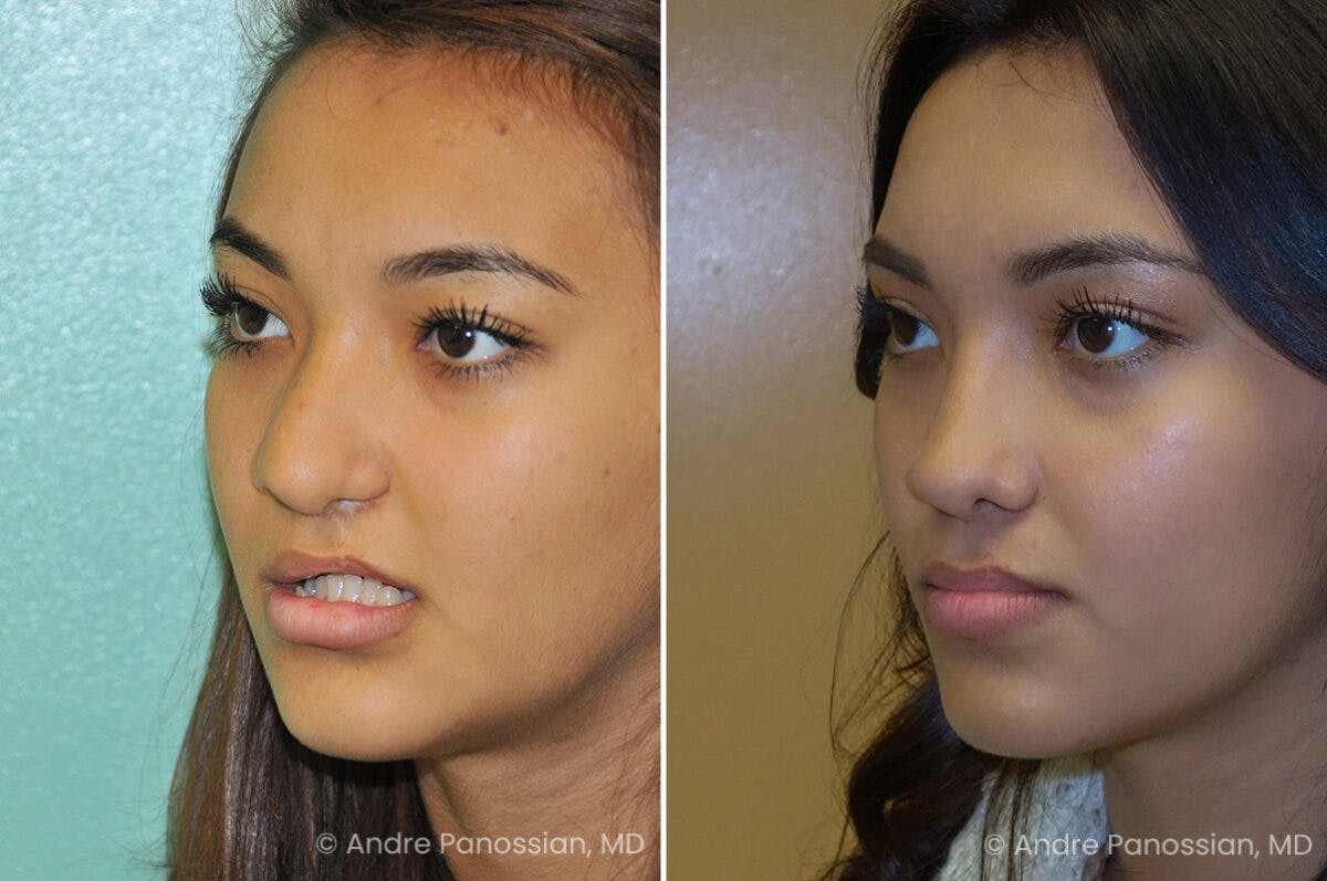 Cleft Lip Rhinoplasty Before & After Gallery - Patient 758720 - Image 3