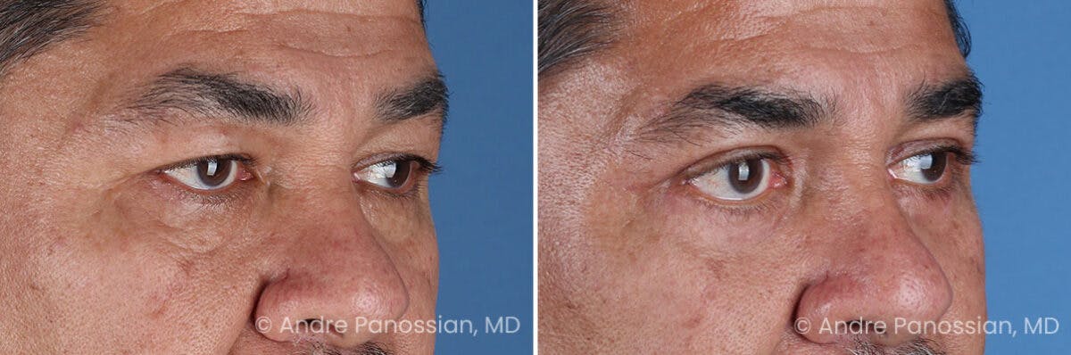 Eyelid Surgery (Blepharoplasty) Before & After Gallery - Patient 389396 - Image 2