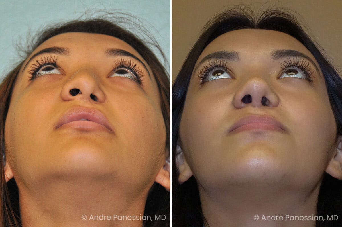 Cleft Lip Rhinoplasty Before & After Gallery - Patient 758720 - Image 4