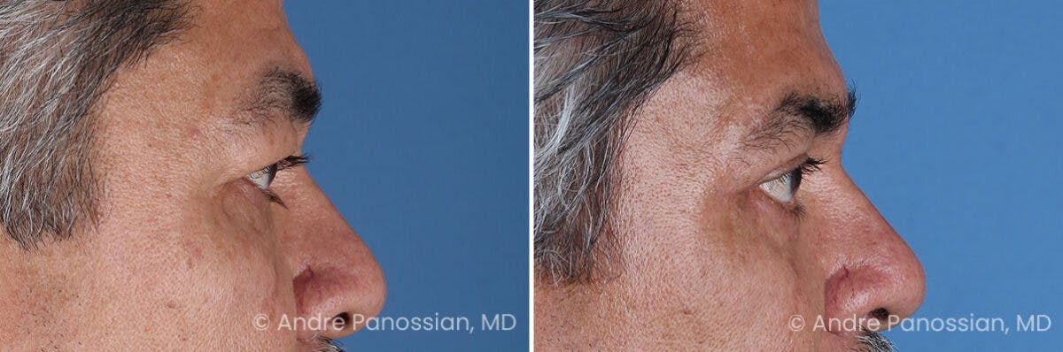 Eyelid Surgery (Blepharoplasty) Before & After Gallery - Patient 389396 - Image 3