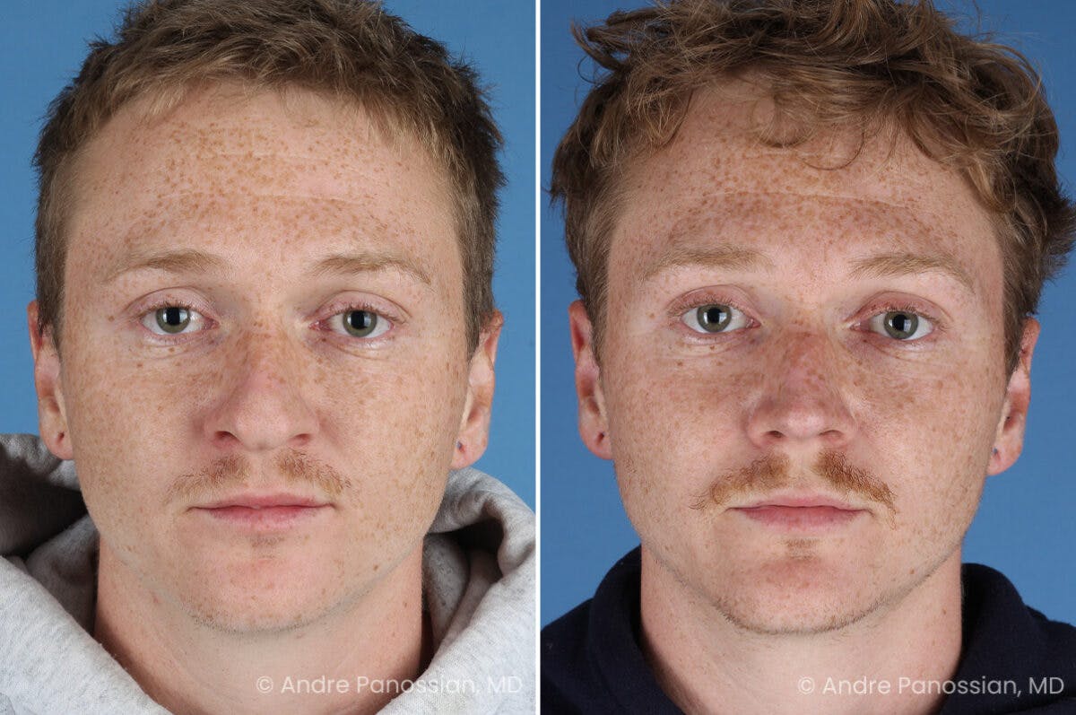Rhinoplasty Before & After Gallery - Patient 433033 - Image 2