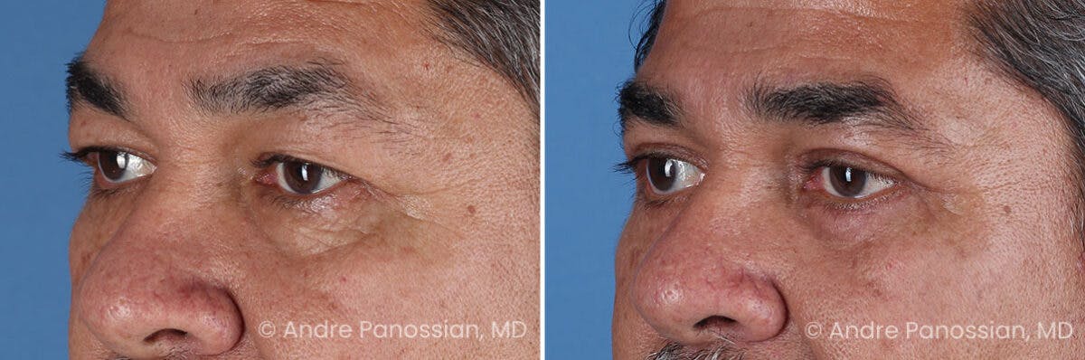 Eyelid Surgery (Blepharoplasty) Before & After Gallery - Patient 389396 - Image 4