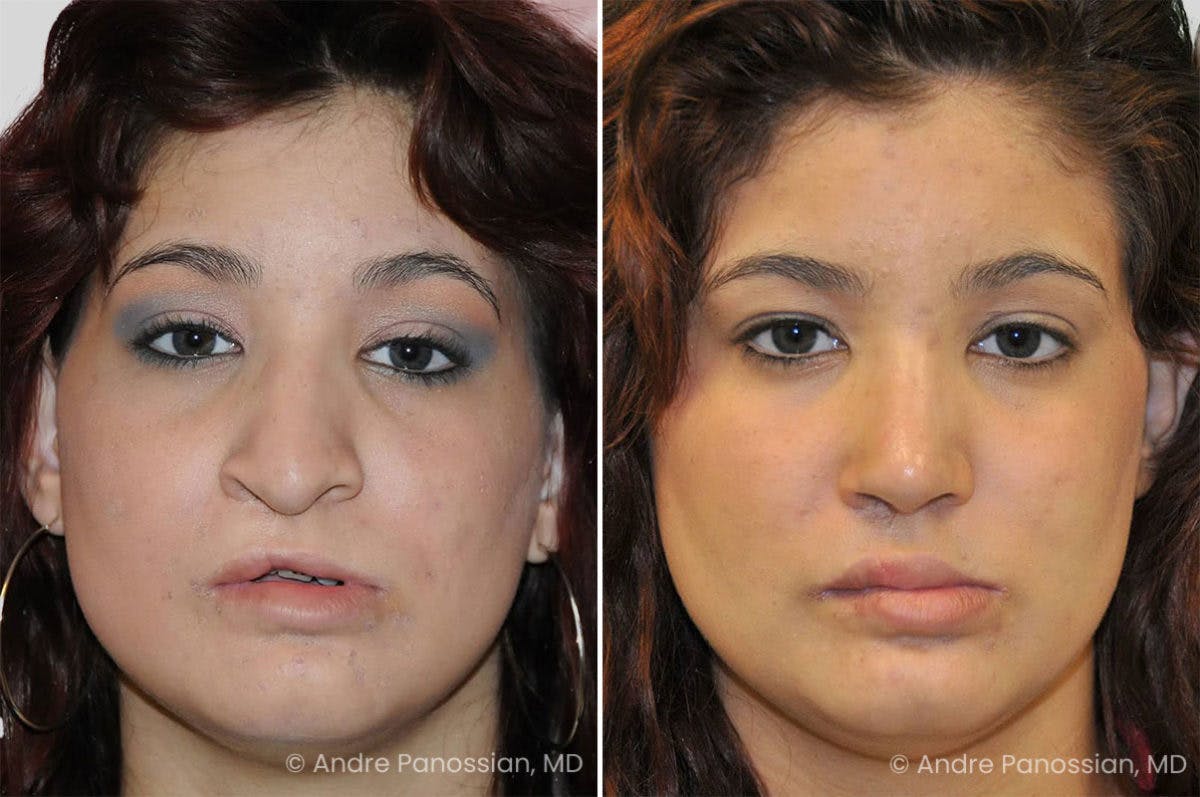 Revision Rhinoplasty Before & After Gallery - Patient 417445 - Image 2