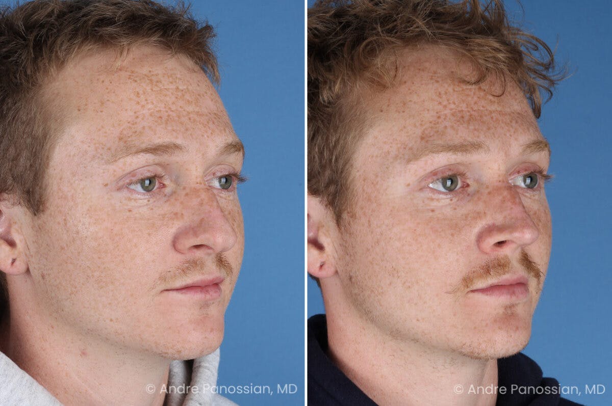Rhinoplasty Before & After Gallery - Patient 433033 - Image 3