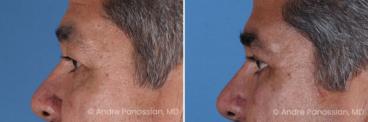 Eyelid Surgery (Blepharoplasty) Before & After Gallery - Patient 389396 - Image 5