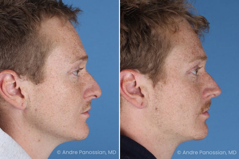 Rhinoplasty Before & After Gallery - Patient 433033 - Image 1