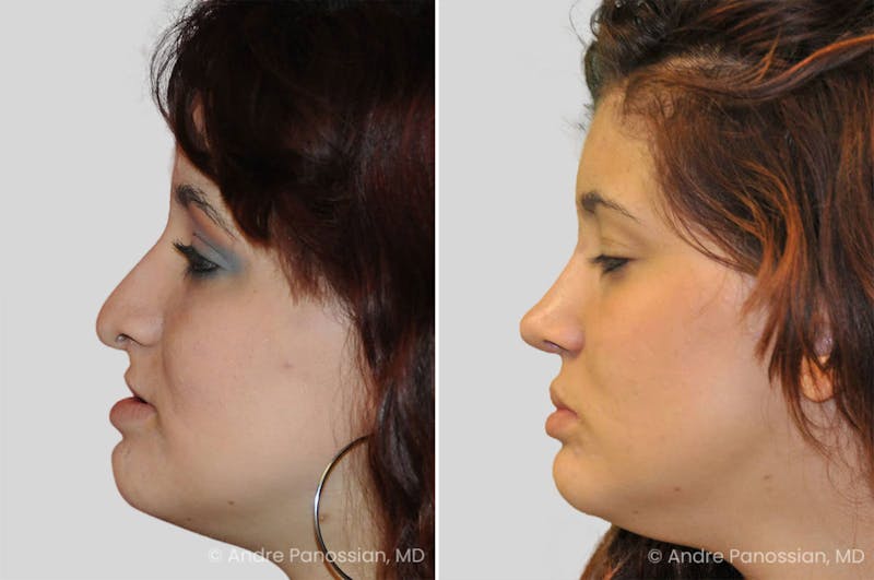 Revision Rhinoplasty Before & After Gallery - Patient 417445 - Image 1