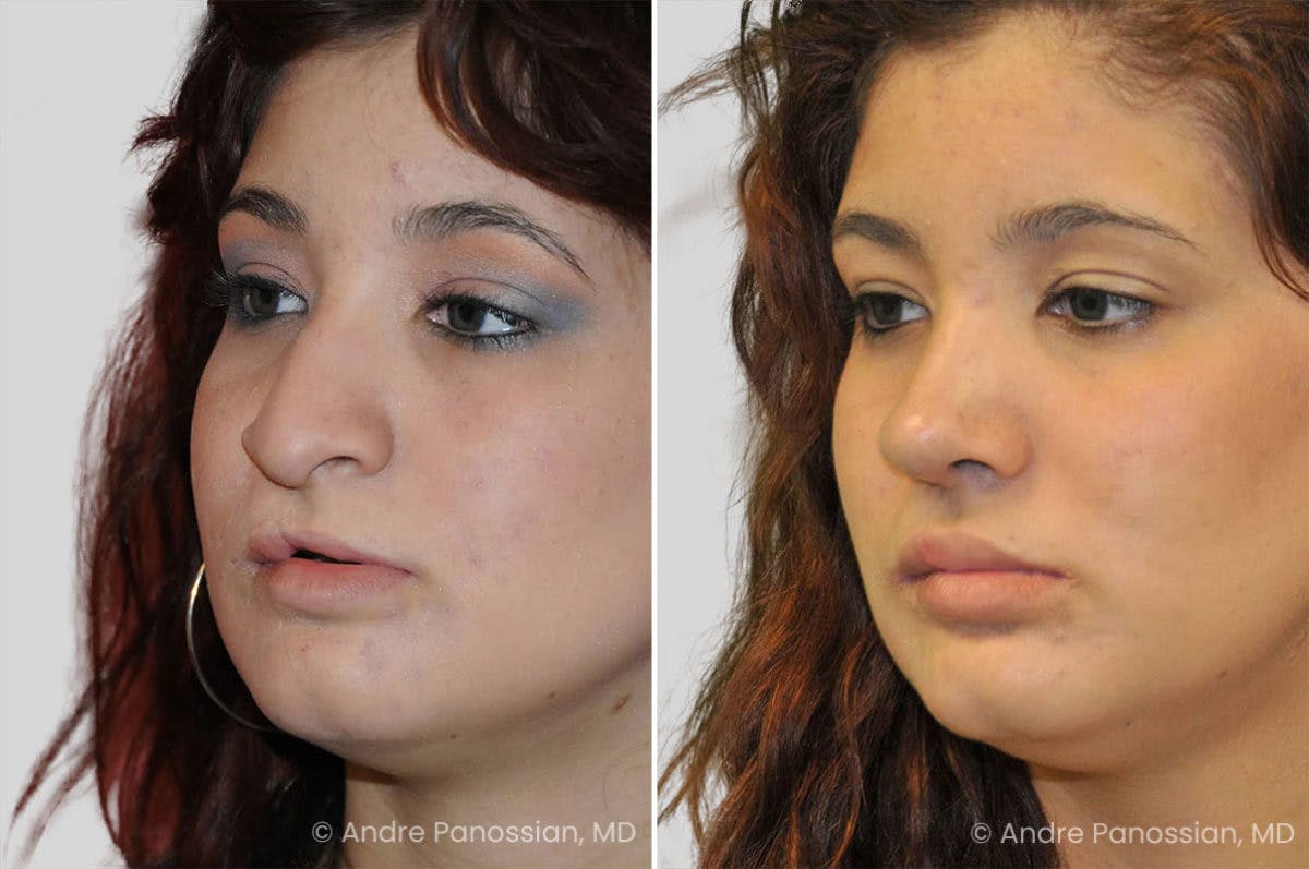 Revision Rhinoplasty Before & After Gallery - Patient 417445 - Image 3