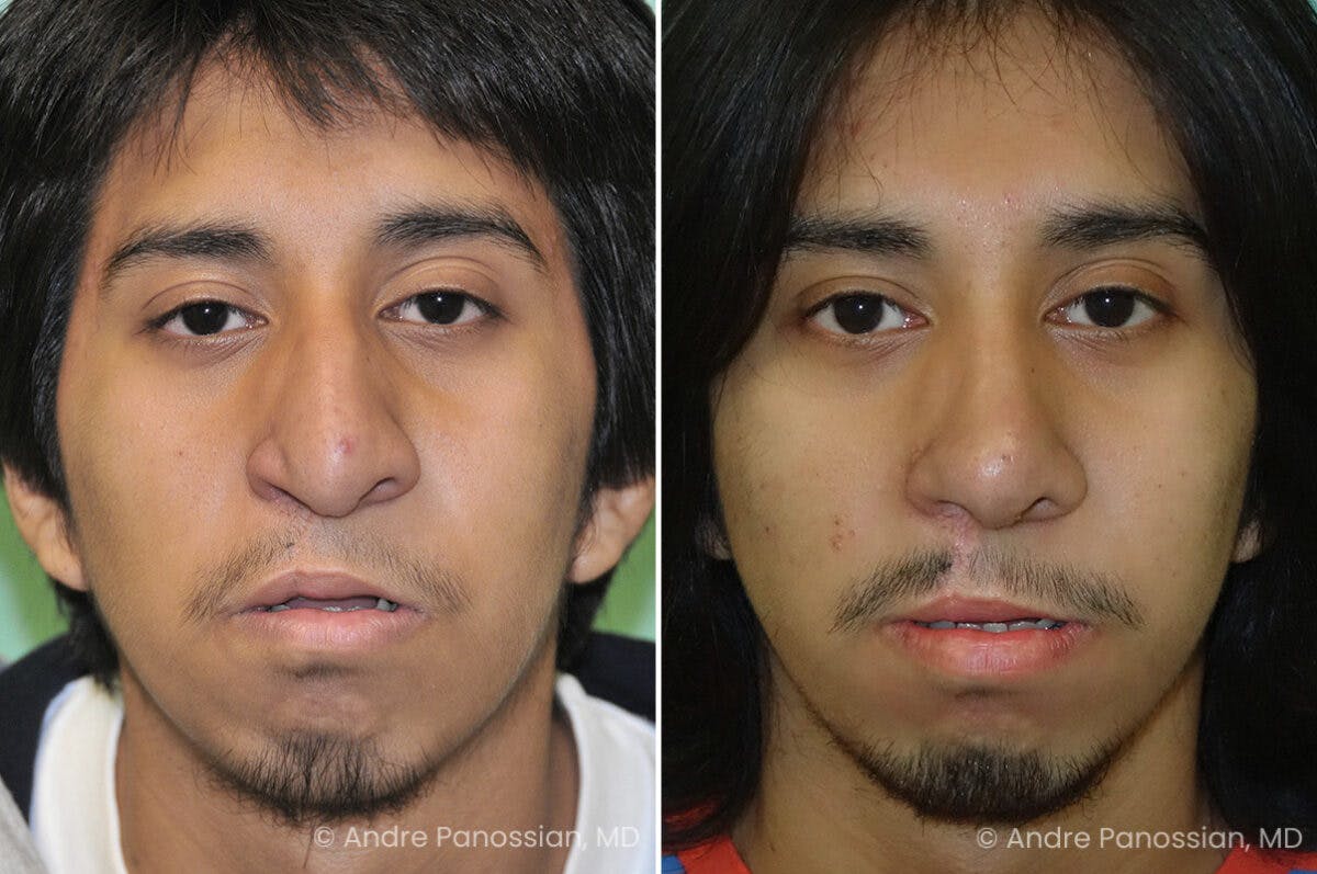 Cleft Lip Rhinoplasty Before & After Gallery - Patient 965507 - Image 2