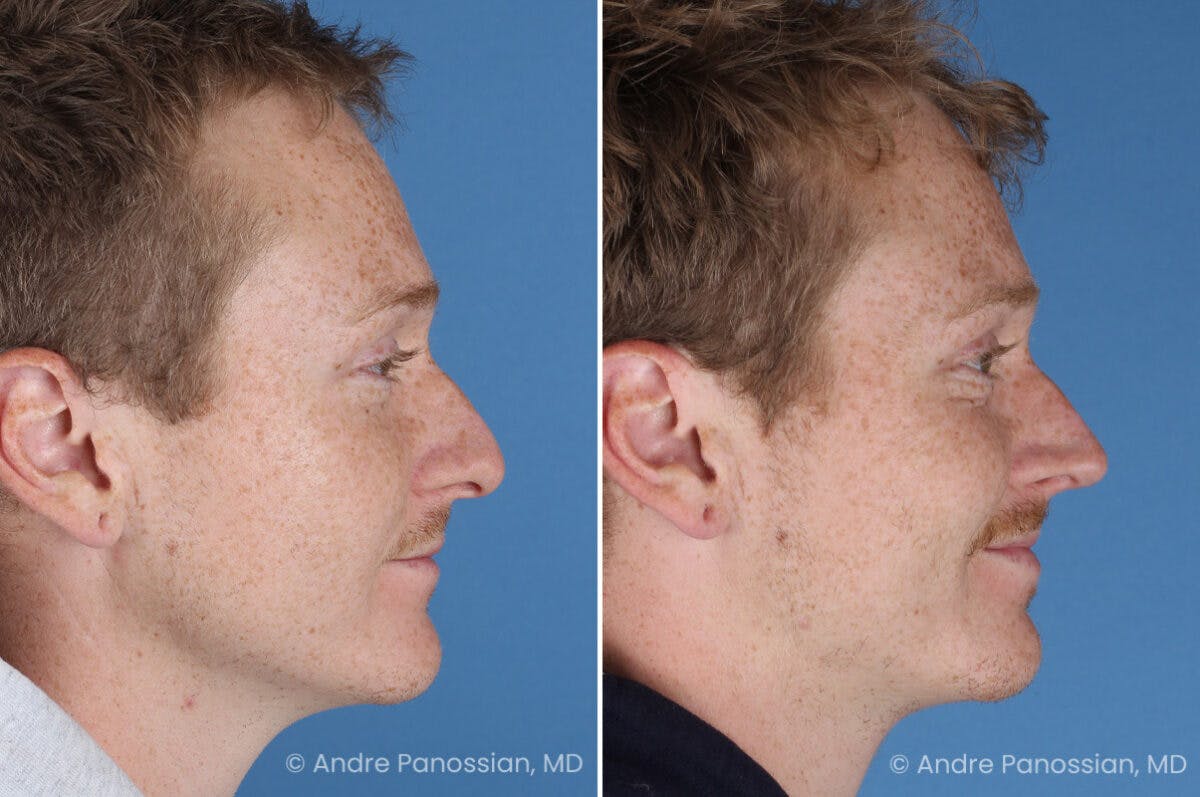 Rhinoplasty Before & After Gallery - Patient 433033 - Image 4