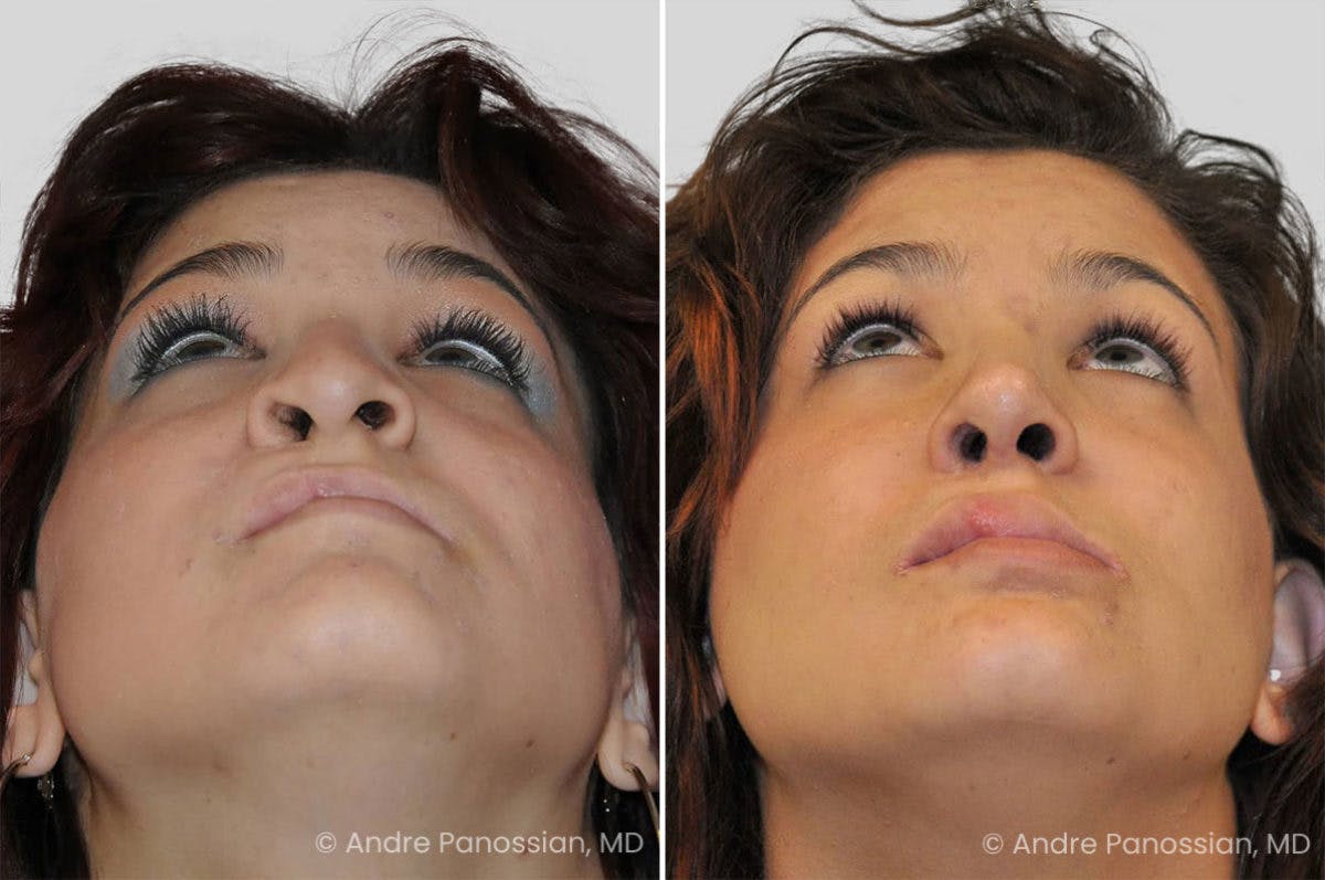 Revision Rhinoplasty Before & After Gallery - Patient 417445 - Image 4