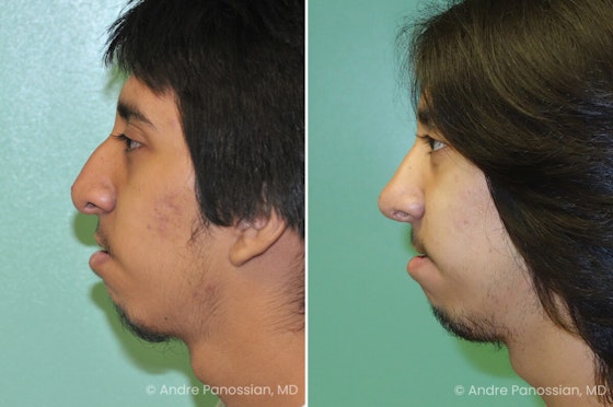 Cleft rhinoplasty before and after — actual patient of Andre Panossian, MD