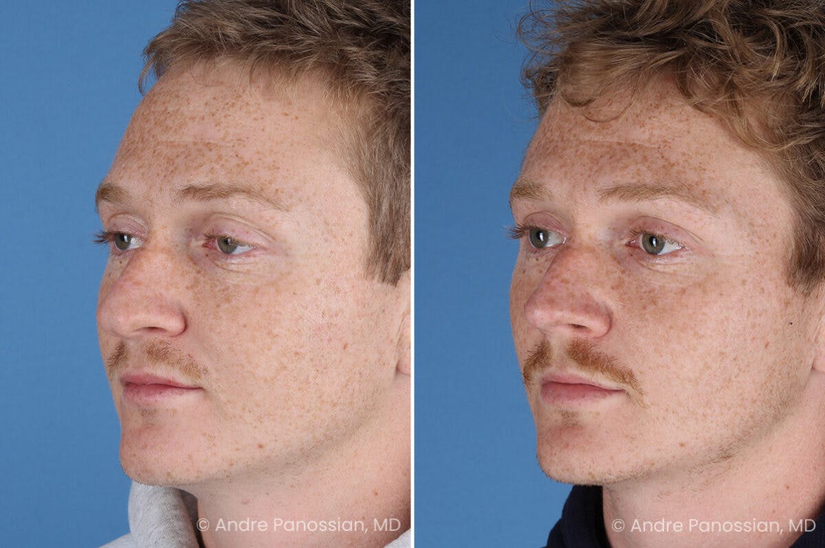 Rhinoplasty Before & After Gallery - Patient 433033 - Image 5