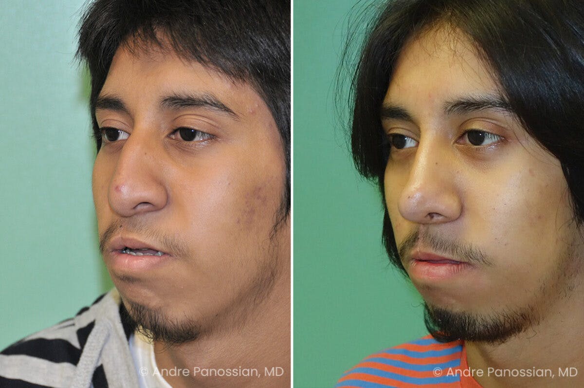 Cleft Lip Rhinoplasty Before & After Gallery - Patient 965507 - Image 3