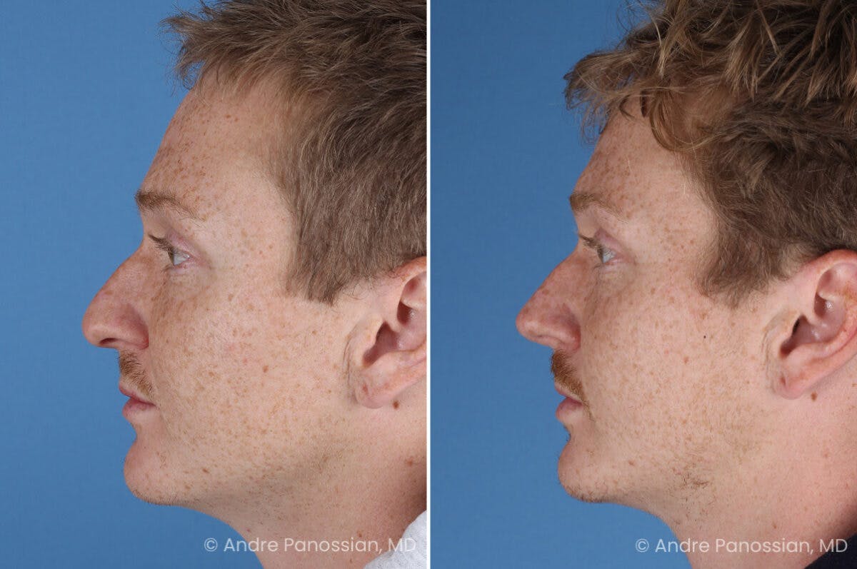 Rhinoplasty Before & After Gallery - Patient 433033 - Image 6